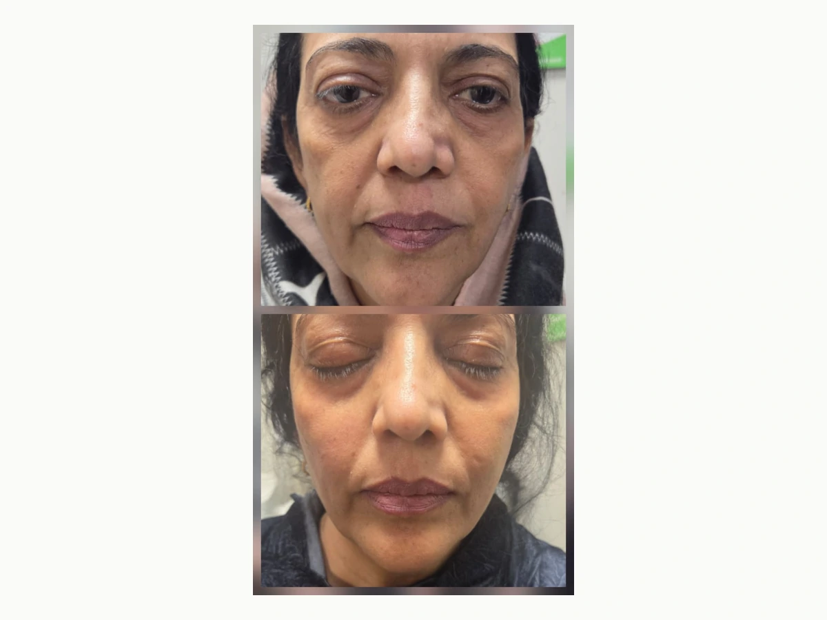Cheek enhancement before and after